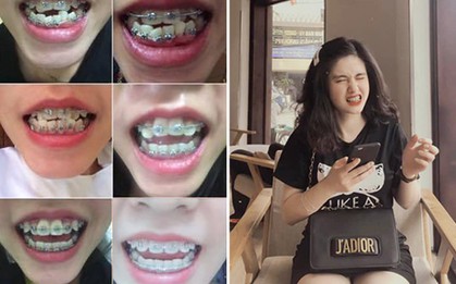 Sau pha niềng răng "chấn động" MXH, nhiều bạn trẻ không ngại chia sẻ hình ảnh "vịt hoá thiên nga" với hàm răng của mình