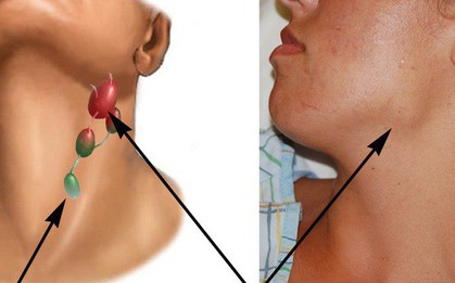 Có 1 loại ung thư ít được để ý nhưng lại cướp đi tính mạng của hàng trăm nghìn người