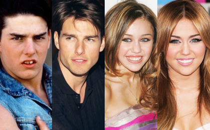 Đâu cần dao kéo, dàn sao thế giới vẫn lột xác kỳ diệu chỉ nhờ niềng răng: Tom Cruise và tài tử "Harry Potter" sốc nhất