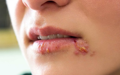Quan hệ đường miệng - một trong những hành vi dễ lây lan bệnh tình dục và đây là loạt bệnh bạn cần biết