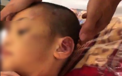 Dư luận phẫn nộ, truy tìm hai phụ nữ hành hạ con riêng đến đa chấn thương