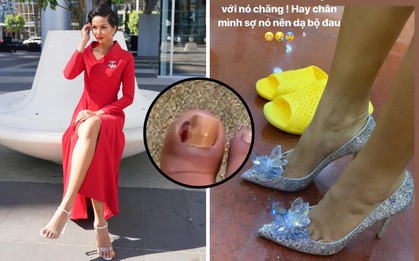 H’Hen Niê phải đi giày cao gót dù ngón chân sưng vù, điều này rất ảnh hưởng sức khỏe nếu cô không chú ý thêm tới những điều sau