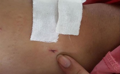 Khoan nhầm cẳng chân của bệnh nhân, đình chỉ công tác hai nhân viên y tế