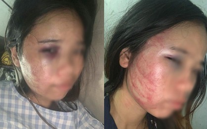 Xót xa người vợ mang bầu 7 tháng vẫn bị chồng đánh bầm dập, đau lòng hơn khi bố ruột vừa mới qua đời