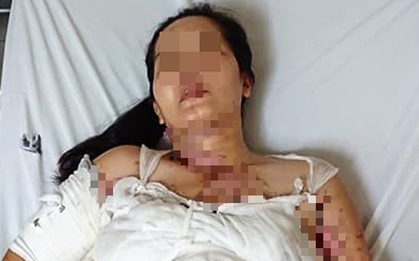 Nấu chè mừng đầy tháng cháu nội, người phụ nữ bị nguyên nồi nước sôi đổ vào người dẫn đến bỏng nặng