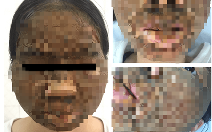 Đáng sợ mặt cô gái 24 tuổi sần sùi như vỏ cây sau khi bôi kem trắng da