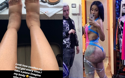 Rùng mình trước quả đắng từ những cuộc đại tu cơ thể của Cardi B: Đôi chân phù nặng vì nghiện “dao kéo”