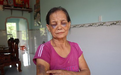 Phẫn nộ con dâu mới sinh 3 tháng đánh mẹ chồng thâm tím mặt rồi khóc lóc xin đừng nói với ai