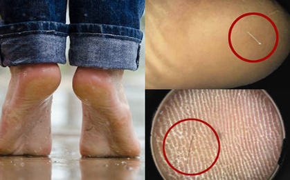Nhập viện vì gót chân quá đau đớn, bệnh nhân không ngờ thủ phạm lại là sợi tóc mỏng manh dài 1cm