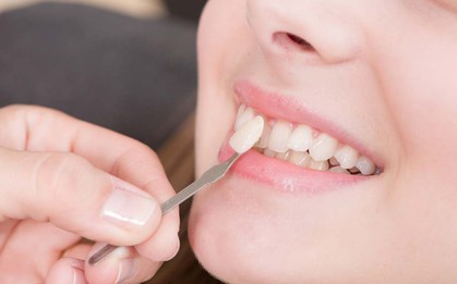 Những điều "tưởng thế mà không phải thế" về công nghệ răng sứ đang được giới trẻ lẫn các sao ưa chuộng