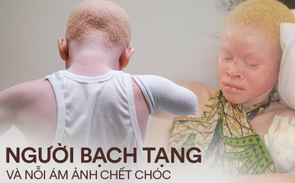 Nỗi bất hạnh của người bạch tạng ở lục địa đen: Bị săn lùng như động vật quý hiếm, đến trẻ nhỏ cũng bị cắt cụt tứ chi vì cuồng tín mê muội