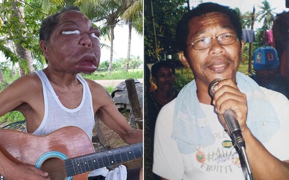 Đang khỏe mạnh, người đàn ông mắc chứng bệnh lạ khiến khuôn mặt sưng phồng gấp 3 lần, biến dạng đến mức không ai nhận ra