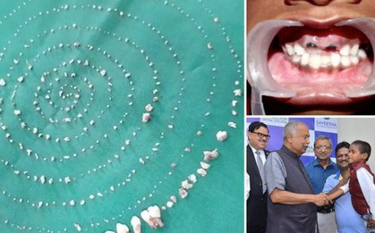Thấy miệng con sưng to, bố mẹ đưa đi khám thì ngã ngửa khi bác sĩ phẫu thuật nhổ ra 526 chiếc răng to bé đủ loại