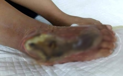Hà Tĩnh: Rắn hổ mang bò vào nhà, cắn bé gái 3 tuổi nguy kịch