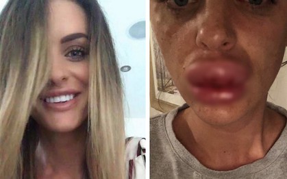 Cô gái khóc thét với đôi môi sưng phù như ong chích sau khi chủ quan tiêm botox tại nhà