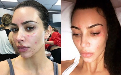 Xót xa mặt mộc của Kim Kardashian: Đường nét quá hoàn hảo nhưng các vết tấy đỏ bất thường gây chú ý lớn