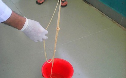 Kinh hãi sán xơ mít dài 7m làm tổ 2 năm trong bụng người đàn ông ở Quảng Nam