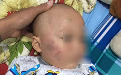 Vĩnh Long: Bé trai 19 tháng tuổi bị bảo mẫu tát liên tục vào mặt, phải nhập viện điều trị