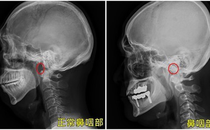 Người đàn ông bị nghẹt mũi, đêm ngủ ngáy, đi khám xong thì sốc bởi phát hiện bệnh nguy hiểm