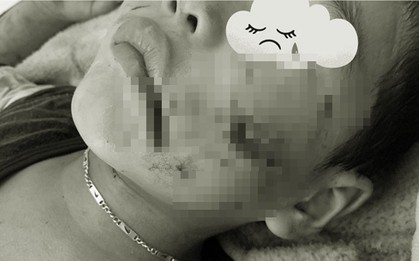 Chó nhà nuôi chưa tiêm phòng dại cắn nát mặt bé trai 5 tuổi ở Sơn La