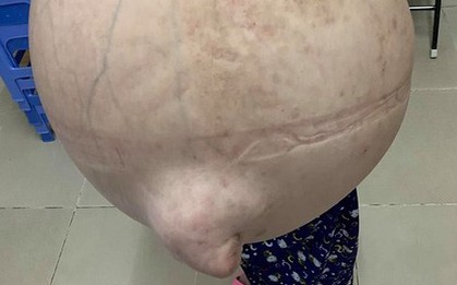 Bác sĩ xót xa với hình ảnh cô gái 19 nhưng chỉ nhỏ như 10 tuổi "cõng" khối u 50kg