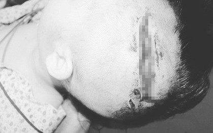 Bé gái 2 tuổi bị chó nhà người thân cắn lộ xương sọ
