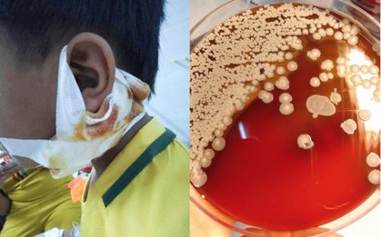 Nghệ An: Sức khỏe 3 bệnh nhi nhiễm vi khuẩn ăn thịt người chuyển biến tốt