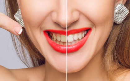 Mẹo nhỏ giúp bạn giải quyết nỗi lo răng ố vàng, nhanh chóng lấy lại nụ cười trắng sáng tự tin