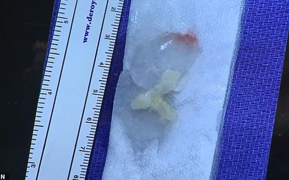 Ăn thịt lợn tái, người đàn ông Texas bị giun dẹp ký sinh "xây dựng tổ ấm" trong não suốt 10 năm