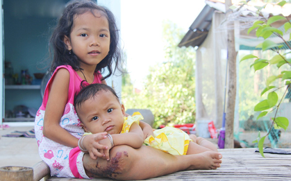 Lời khẩn cầu của bé gái 7 tuổi bị bướu máu ác tính, có nguy cơ cắt bỏ chân phải nếu không đủ tiền phẫu thuật