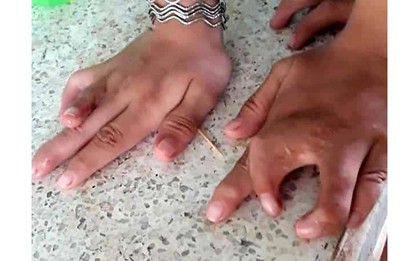 Một dòng họ ở Tiền Giang bị dị tật "càng cua" hiếm gặp