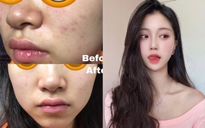 Biết 5 chiêu nặn mụn đúng cách, da sẽ nhanh lành, vết thâm cũng không có cửa xuất hiện