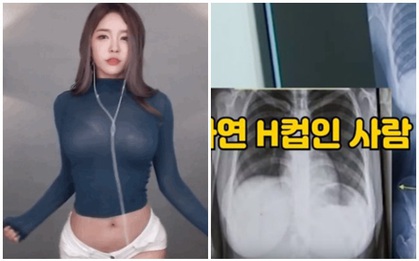 Nhảy quá sung trên sóng, nữ streamer phải đi viện vì đau lưng, vô tình bị fan soi ra vòng ngực cup H sau khi chụp X-quang