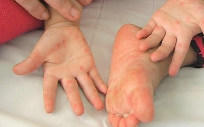 1 trường mầm non ở Hà Nội khiến phụ huynh bức xúc vì giấu kín chuyện học sinh bị bệnh truyền nhiễm, nhiều em bị lây sau đó