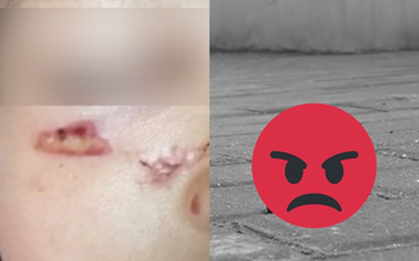 Bé gái 4 tuổi bất ngờ bị bỏng mặt khi đang trong vòng tay của bố, sự thật về thứ "từ trên trời rơi xuống" khiến ai cũng phẫn nộ