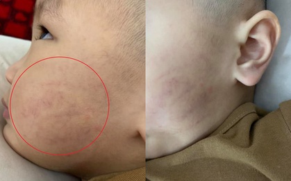 Phụ huynh tố cô giáo tát bé 21 tháng thâm tím mặt, in dấu tay lên má: Con hoảng loạn sợ hãi, về bám chặt người nhà, thấy cô giáo là khóc thét