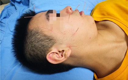 Chàng trai 20 tuổi không thể nhắm mắt, méo miệng, liệt mặt - tất cả bắt nguồn từ thói quen mà nhiều người trẻ vẫn làm hàng đêm