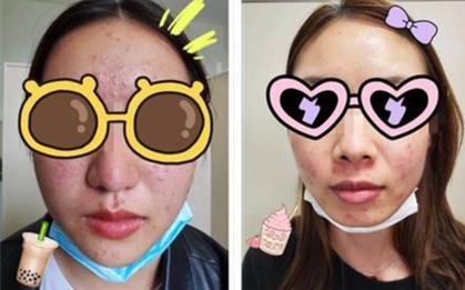 Uống trà sữa mỗi ngày, 2 cô gái trùm khăn kín bưng đến bệnh viện vì bị mọc mụn đầy mặt