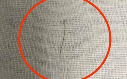 Phẫu thuật lấy mảnh thép dài 2cm cắm vào thành họng bé 13 tháng tuổi