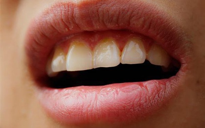 Miệng khô và cứ đắng ngắt khi thức dậy vào buổi sáng, nguyên nhân là đây