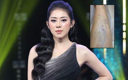 Hot girl "Người ấy là ai" bị teo cơ, giãn tĩnh mạch do tiêm xóa thâm sai cách: "Sẽ đi Singapore khám sớm để tránh gây thêm biến chứng"