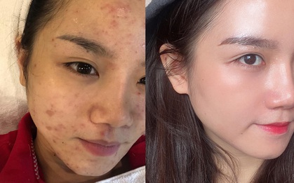 Trải qua thời kỳ da xấu thậm tệ, cô nàng này đã có cuộc cải tổ skincare với cách bôi kem chống nắng chẳng giống ai