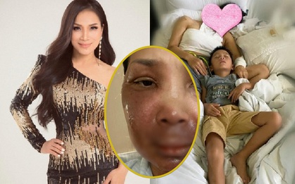 Ca sĩ Hồng Ngọc hé lộ ảnh cận vết bỏng nặng trên mặt, dàn nghệ sĩ Vbiz chạnh lòng rơi nước mắt