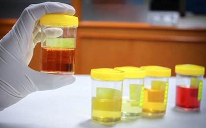 Thấy nước tiểu luôn có màu vàng sẫm: chưa chắc là cảnh báo thận yếu, nguyên nhân có thể do những điều khác