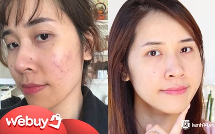 3 sản phẩm skincare thực sự cứu các beauty blogger khỏi cảnh thâm mụn, kiểu gì bạn cũng nhặt được ít nhất một món thật "xịn"