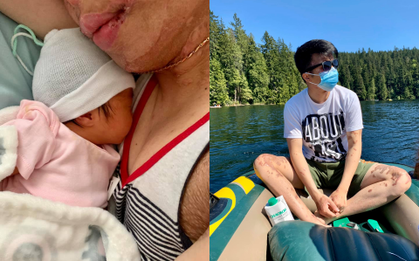 Cuộc sống của Việt kiều Canada sau 1 năm rưỡi bị cắt gân chân và tạt axit: Chào đón "thiên thần nhỏ" sau quãng thời gian khó khăn