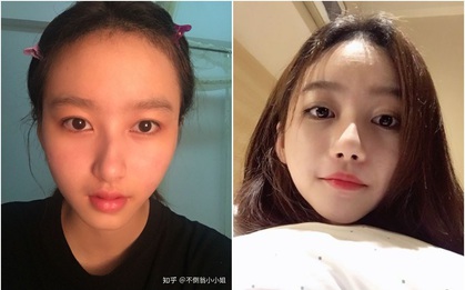 Sửa mũi sương sương, gái xinh vừa hết tự ti, vừa nâng tầm nhan sắc lên gấp bội