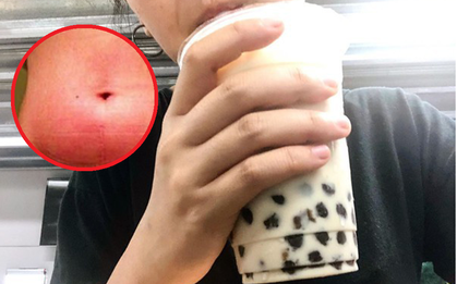 Mỗi ngày uống 1 cốc trà sữa trân châu, sau 8 năm, cô gái 34 tuổi được chẩn đoán ung thư buồng trứng