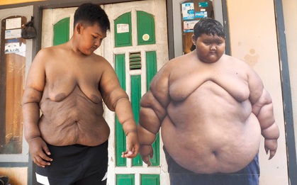 Hành trình giảm cân ngoạn mục của cậu bé béo nhất thế giới nặng gần 200kg khi mới 10 tuổi nhưng để lại cơ thể bị chảy xệ gây ám ảnh