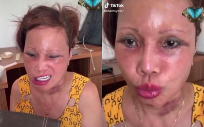 Xôn xao hình ảnh gương mặt sưng phù, biến dạng của "cô dâu 62 tuổi" và sự cưng nựng của chồng trẻ kém 36 tuổi gây bất ngờ